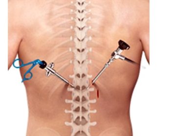Minimal-invasive-spine-surgery