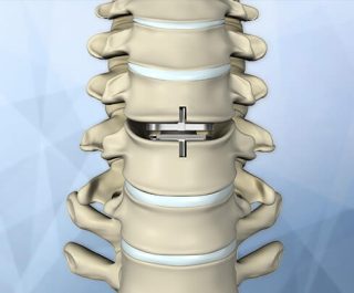 cervical-disc-replacement